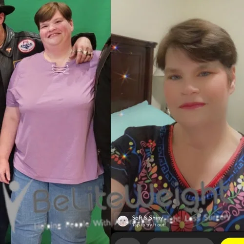 Weight Loss Surgery Gastric Sleeve before and after